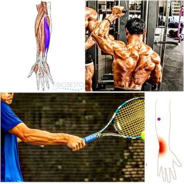 Extensor cubital del carpo:
